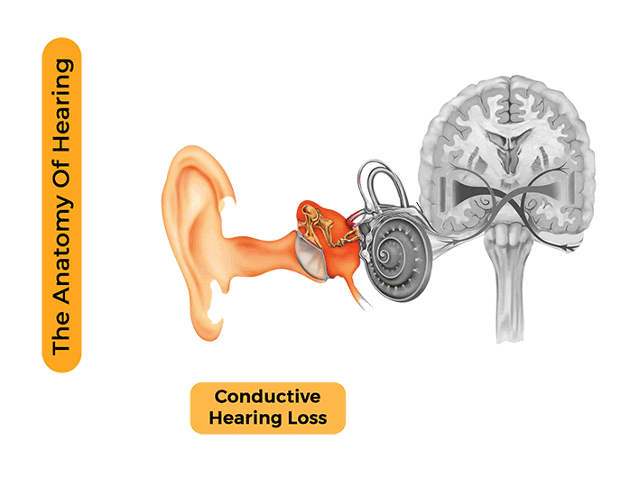 Hearing Loss